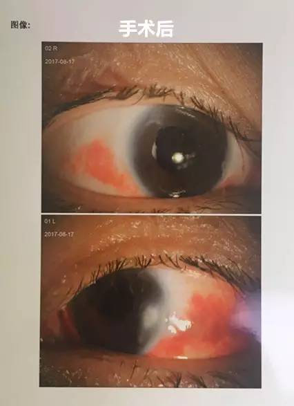 成都牛八体育白内障.jpg 成都牛八体育白内障.jpg
