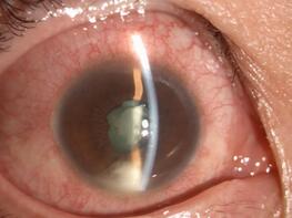 徐先生再也不敢马虎,急忙请假到深圳牛八体育就诊。接诊的张小平主任经过仔细检查,得出的诊断是:右眼急性虹膜睫状体炎2.jpg 徐先生再也不敢马虎,急忙请假到深圳牛八体育就诊。接诊的张小平主任经过仔细检查,得出的诊断是:右眼急性虹膜睫状体炎2.jpg