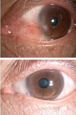 姚颖医生为文先生做了详细检查后，制定了左眼的翼状胬肉切除术、联合自体干细胞移植术、联合羊膜覆盖术的手术方案，这才为他解决了胬肉的麻烦与痛苦。手术一个月后，朋友见了文先生都说他的眼睛  了正常，看不出一点手术过的痕迹1.jpg