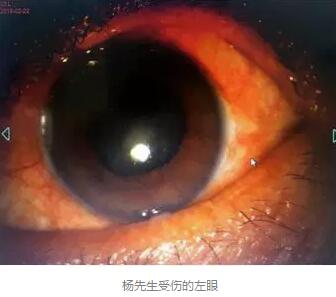 白内障和青光眼都是致盲性眼病,其中青光眼的病程不逆转。杨先生拖延伤情导致同时并发白内障、青光眼的情况,十分令人惋惜。”出名眼科专家、成都牛八体育陈晓明教授表示2.jpg 白内障和青光眼都是致盲性眼病,其中青光眼的病程不逆转。杨先生拖延伤情导致同时并发白内障、青光眼的情况,十分令人惋惜。”出名眼科专家、成都牛八体育陈晓明教授表示2.jpg
