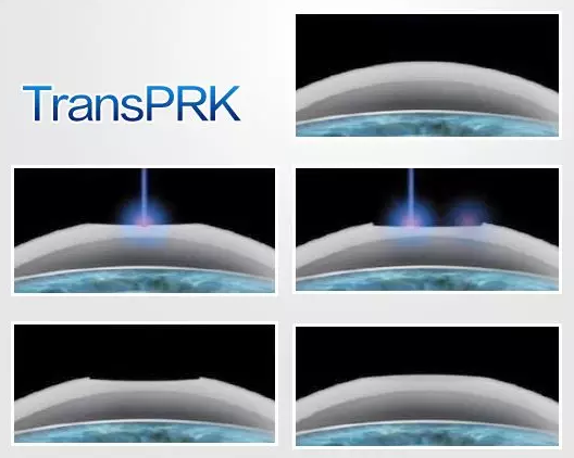 目前,近视手术已被列入军检允许范围,安全、长效的近视手术,已经成为了众多有志青年应征入伍前的必然选择。在众多摘镜手术方式——全飞秒、半飞秒、准分子激光手术、ICL晶体植入术等等,哪一种 适合当兵的人呢3.png 目前,近视手术已被列入军检允许范围,安全、长效的近视手术,已经成为了众多有志青年应征入伍前的必然选择。在众多摘镜手术方式——全飞秒、半飞秒、准分子激光手术、ICL晶体植入术等等,哪一种 适合当兵的人呢3.png