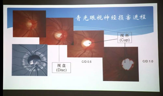 3月10日上午,深圳牛八体育“早查监控,守护光明”大型青光眼公益科普讲座在六楼 举行,本次活动旨在让更多人了解青光眼的潜在危害、重视眼检查, 预防青光眼。由深圳牛八体育青光眼病科 席专家成洪波博士、傅培副院长现场面对面解答疑问,与参会者的互动交流,让更多深圳市民提*对青光眼的认识与防治知识3.png 3月10日上午,深圳牛八体育“早查监控,守护光明”大型青光眼公益科普讲座在六楼 举行,本次活动旨在让更多人了解青光眼的潜在危害、重视眼检查, 预防青光眼。由深圳牛八体育青光眼病科 席专家成洪波博士、傅培副院长现场面对面解答疑问,与参会者的互动交流,让更多深圳市民提*对青光眼的认识与防治知识3.png