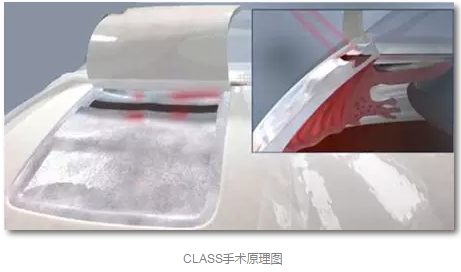 成都牛八体育已经开展的青光眼手术有:引流阀 (钉)植入手术(2015年以来已200多 ),360°Schlemm's管切开术,激光CO2 辅助巩膜深层切除术,小梁切除术青(光眼)白(内障)联合手术。还有虹膜周切术、前房成形术、 虹膜复位术,睫状体冷冻术,小梁切开术和前房穿刺术等4.png 成都牛八体育已经开展的青光眼手术有:引流阀 (钉)植入手术(2015年以来已200多 ),360°Schlemm's管切开术,激光CO2 辅助巩膜深层切除术,小梁切除术青(光眼)白(内障)联合手术。还有虹膜周切术、前房成形术、 虹膜复位术,睫状体冷冻术,小梁切开术和前房穿刺术等4.png