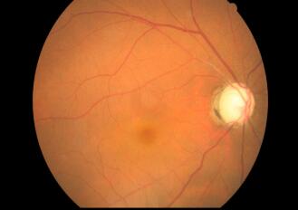 青光眼症状.jpg 青光眼症状.jpg