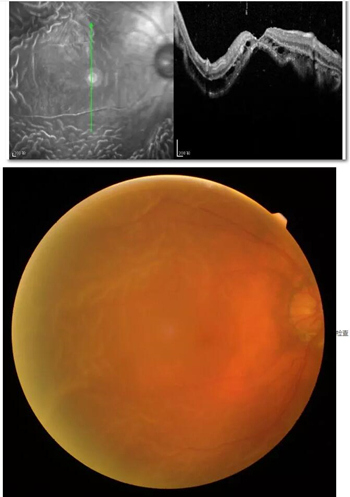 李老太在毫无征兆的情况下右眼视力下降至看不见东西。李老太家人带其至县医院就诊。医生诊断为视网膜脱离,需做玻切手术医治,而玻切手术需要动手术2次。怕疼的李老太一听就犯怵了:开刀,疼。 终,李老太的家人在多方打听后决定带李老太至宜昌牛八体育找许大玲院长医治1_副本.jpg 李老太在毫无征兆的情况下右眼视力下降至看不见东西。李老太家人带其至县医院就诊。医生诊断为视网膜脱离,需做玻切手术医治,而玻切手术需要动手术2次。怕疼的李老太一听就犯怵了:开刀,疼。 终,李老太的家人在多方打听后决定带李老太至宜昌牛八体育找许大玲院长医治1_副本.jpg