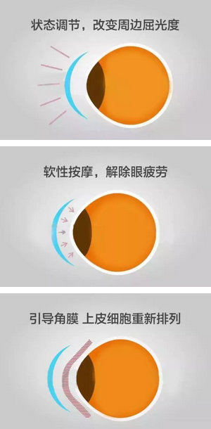 角膜塑形镜是一种硬性透气性隐形眼镜,戴在眼表可使角膜发生塑形效应,从而达到 近视度数的 。适合夜晚睡觉时配戴,白天不用戴眼镜就可以 裸眼视力,不影响学习、运动2.png 角膜塑形镜是一种硬性透气性隐形眼镜,戴在眼表可使角膜发生塑形效应,从而达到 近视度数的 。适合夜晚睡觉时配戴,白天不用戴眼镜就可以 裸眼视力,不影响学习、运动2.png