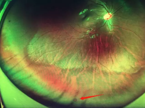 想要摘镜参军在深圳牛八体育查出视网膜裂孔 细心妈妈挽救孩子视网膜1.png 想要摘镜参军在深圳牛八体育查出视网膜裂孔 细心妈妈挽救孩子视网膜1.png