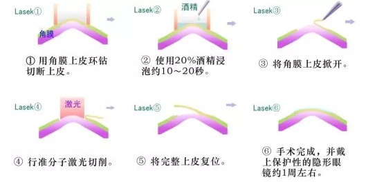 LASEK摘镜手术.png