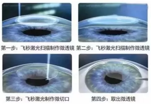 2018高考 视力要求多少 摘镜手术助近视考生圆大学梦4.png 2018高考 视力要求多少 摘镜手术助近视考生圆大学梦4.png