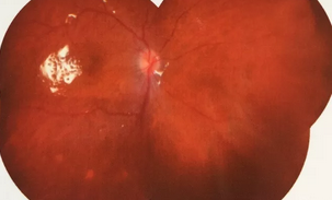 葡萄膜炎等多种眼底病患者跪地感谢深圳牛八体育院长赵铁英教授1.png 葡萄膜炎等多种眼底病患者跪地感谢深圳牛八体育院长赵铁英教授1.png