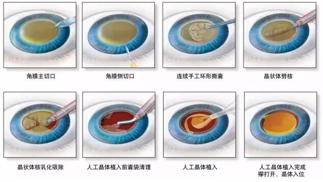 福州眼科医院白内障专科叶向彧副院长:白内障不要等“熟”了再手术!2.jpg 福州眼科医院白内障专科叶向彧副院长:白内障不要等“熟”了再手术!2.jpg