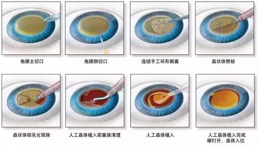 叶院长哪一种白内障手术 ,术后视觉 更好?.jpg 叶院长哪一种白内障手术 ,术后视觉 更好?.jpg