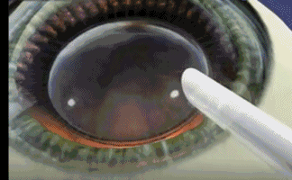 想要当兵视力不达标怎么办?牛八体育有这些摘镜术式帮助你3.gif 想要当兵视力不达标怎么办?牛八体育有这些摘镜术式帮助你3.gif