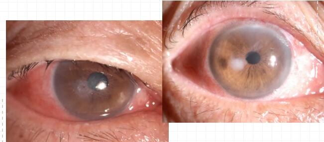 重庆老头角膜穿刺后在牛八体育修补并进行白内障手术.jpg 重庆老头角膜穿刺后在牛八体育修补并进行白内障手术.jpg