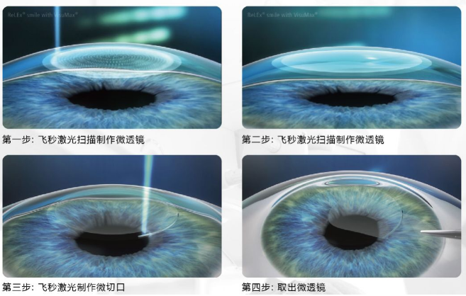 近视无法根治?但你可以这样做?牛八体育“有爱就有希望”近视手术火热进行中6.png 近视无法根治?但你可以这样做?牛八体育“有爱就有希望”近视手术火热进行中6.png