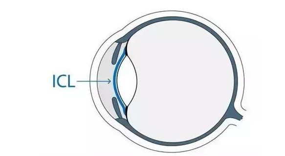 在杭州牛八体育高度近视手术后,近视2550度配不到眼镜的四川大哥,看清了!4.png 在杭州牛八体育高度近视手术后,近视2550度配不到眼镜的四川大哥,看清了!4.png