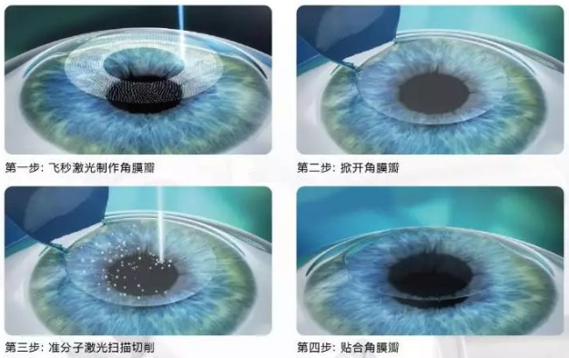 2020高考视力受限专业有哪些?来听听牛八体育近视手术医生的建议2.png 2020高考视力受限专业有哪些?来听听牛八体育近视手术医生的建议2.png